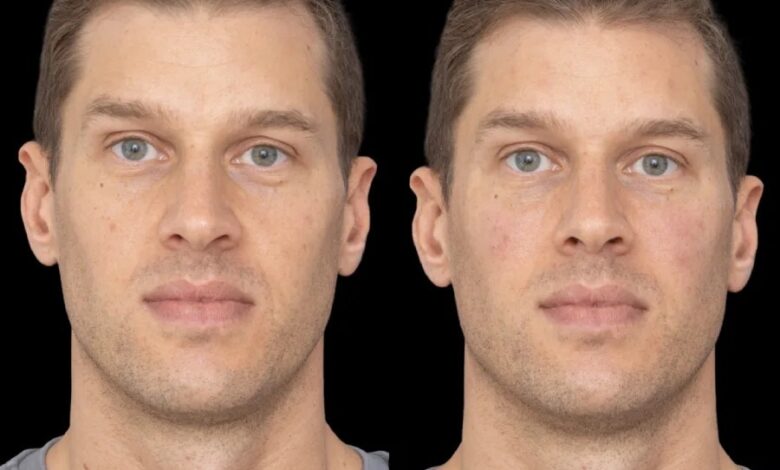 Expert Recommendations on Under Eye Fillers in Dubai Expert Recommendations on Under Eye Fillers in Dubai