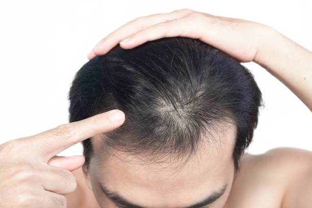 Does GFC Treatment Work for Stress Hair Loss? Does GFC Treatment Work for Stress Hair Loss?