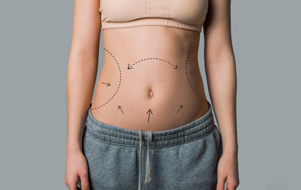 How Liposuction Refines Natural Body Shape ? How Liposuction Refines Natural Body Shape ?