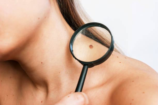 What Makes Modern Mole Removal So Precise? What Makes Modern Mole Removal So Precise?