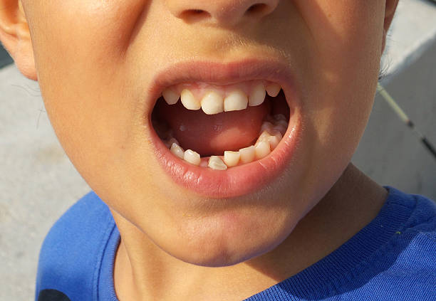 Frequently Asked Questions About Tooth Fracture Treatment in Islamabad Frequently Asked Questions About Tooth Fracture Treatment in Islamabad