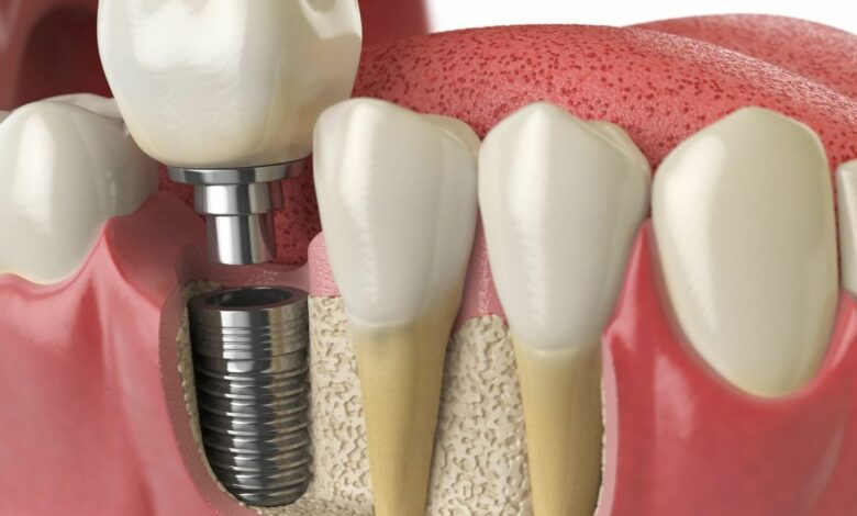 How Dental Implants Help Prevent Shifting Teeth After Tooth Loss How Dental Implants Help Prevent Shifting Teeth After Tooth Loss