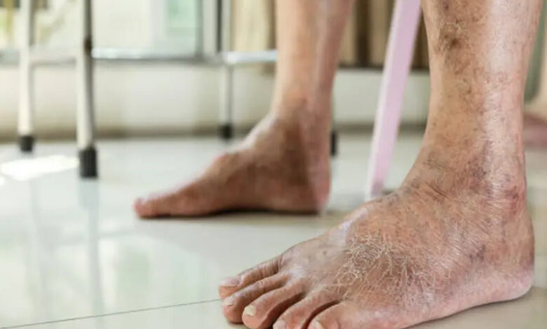 What Is Vascular Disease? Symptoms, Causes, Diagnosis, and Prevention What Is Vascular Disease? Symptoms, Causes, Diagnosis, and Prevention