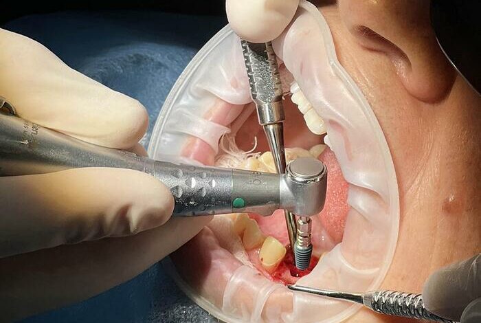 Why Dental Implants in Simi Valley May Be Worth Considering Why Dental Implants in Simi Valley May Be Worth Considering