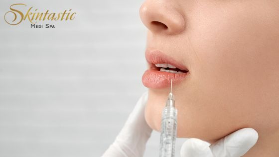 Lip Fillers Riverside for Soft Volume and a Refined Lip Shape Lip Fillers Riverside for Soft Volume and a Refined Lip Shape