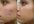 Acne-scar-laser-removal