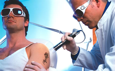 Tattoo Removal