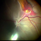A still from Steven Cantor's "The Bionic Eye"