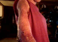 Survived after getting Flesh Eating Bacteria