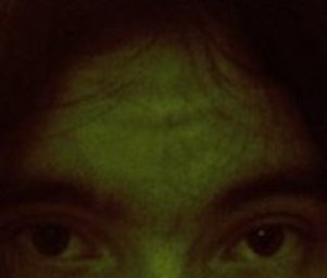 Cerebral_scars_ffff