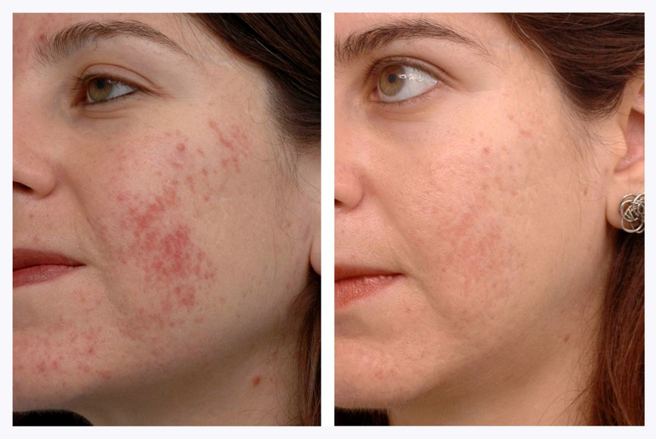 Reduce Acne with Laser Treatment at The Hogarth Medispa in Chiswick West London