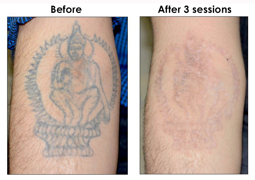 Tattoo Removal at The Hogarth Medispa in Chiswick West London
