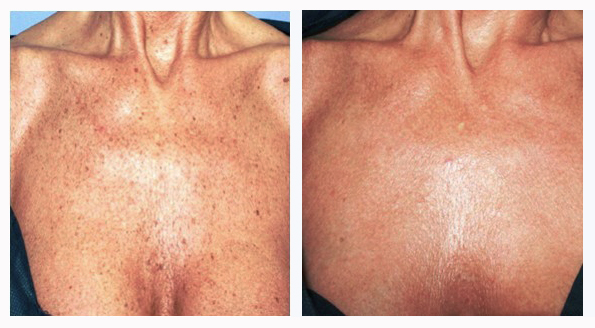 Chest Pigmentation Laser Treatment at The Hogarth Medispa Chiswick West London