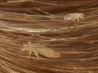 Head-lice-top