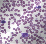 mononucleosis bg