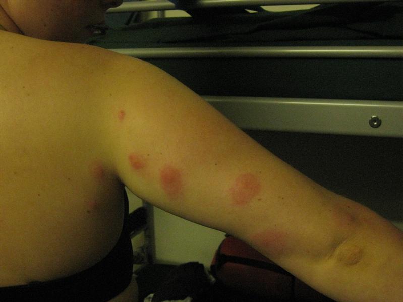 The evidence of the mossie bites :(