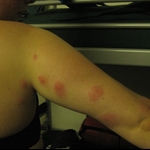 The evidence of the mossie bites :(