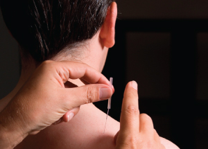 Acupuncture