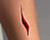 Open Wound
