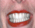 Whiten Teeth