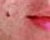Mole Removal