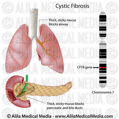 Fibrose cística