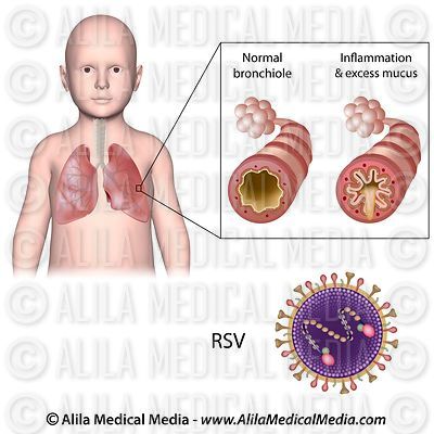 Bronchiolitis caused by RSV