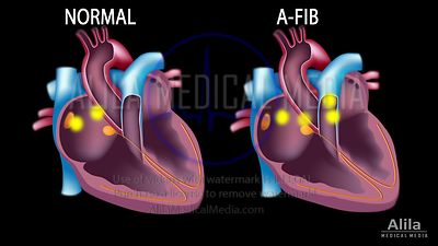 Fibrillation auriculaire vs rythme sinusal normal, animation