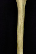 Humerus, septal aperture