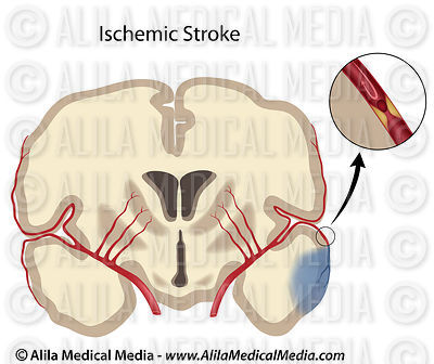Acidente cerebral isquêmico