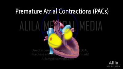 Contractions atriales prématurées, animation en Anglais