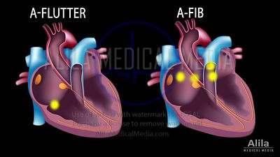 Fibrillation auriculaire versus flutter auriculaire