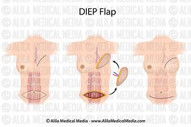 Cervical cancer Operation
