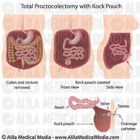 Alila Medical Media | Total Proctocolectomy with Kock Pouch | Medical ...