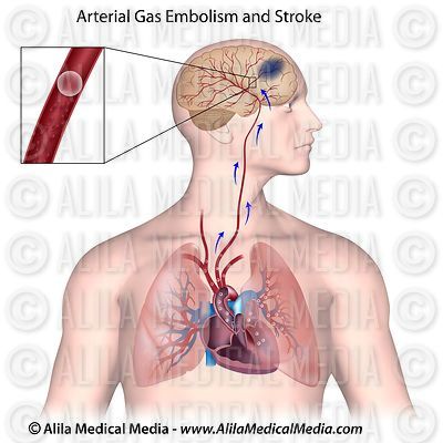 Embolia gás e acidente vascular cerebral