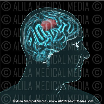 Tumor cerebral