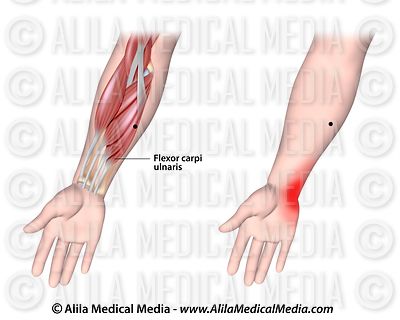 Alila Medical Media | Pain Management Images and Videos