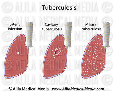Types de tuberculose: infection latente, tuberculose juvénile et miliaire