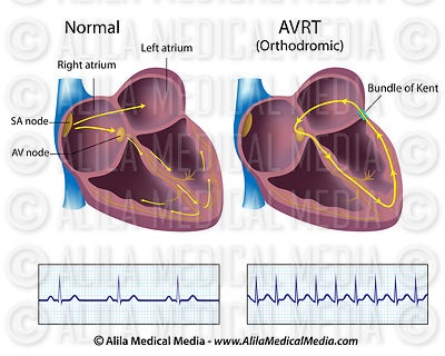 AVRT labeled