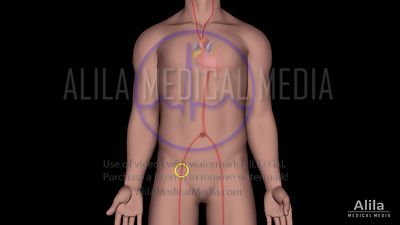 Embolisation endovasculaire pour anévrismes cérébraux, sans et avec stent, animation.