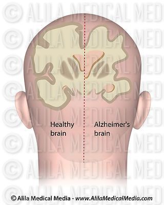 Cérebro saudável vs. Cérebro de Alzheimer