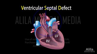 Défaut septal ventriculaire, animation en Anglais