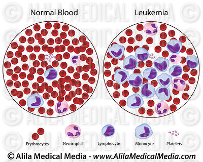 Leukemia versus normal blood