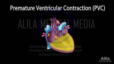 Contraction ventriculaire prématurée, animation en anglais