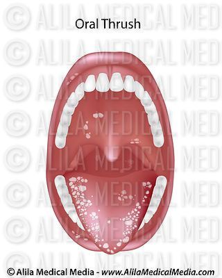 Oral thrush, candidiasis