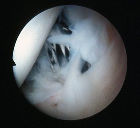 View of the intercondylar notch following repair to anterior cruciate ligament with Surgicraft ABC carbon fibre polyester ligament, immediately after implantation.