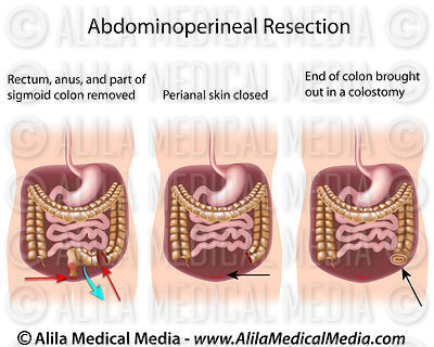 Abdominoperineal resection diagram