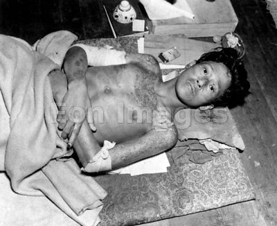 WWII bomb victim in Nagasaki