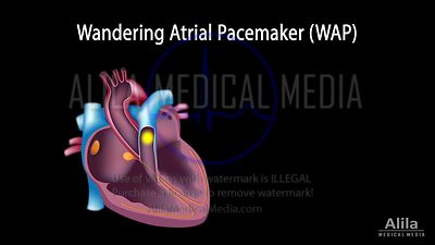 Pacemaker auriculaire errant et tachycardie auriculaire multifocale, animation