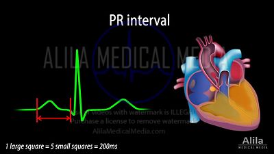 Comment lire les ECG, animation en Anglais, partie 2
